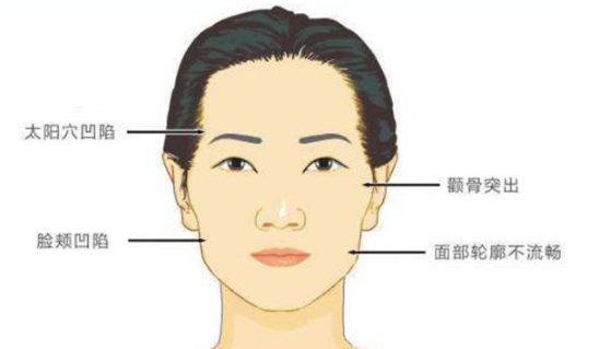 太阳穴凹陷填充适用人群体介