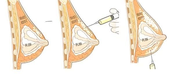 什么是注射丰胸(注射丰胸详