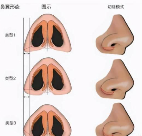 国内做鼻翼缩小手术需要多少钱(鼻翼缩小费用)?