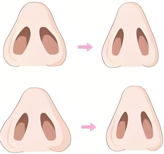 多种缩小鼻孔方法讲解(如何让鼻孔缩小)