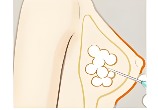 注射丰胸后会不会影响哺乳? 