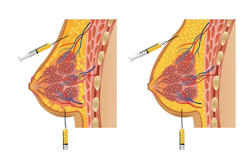 注射丰胸禁忌有哪些? 