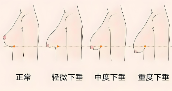 各城市治疗乳房下垂手术需要多少钱?