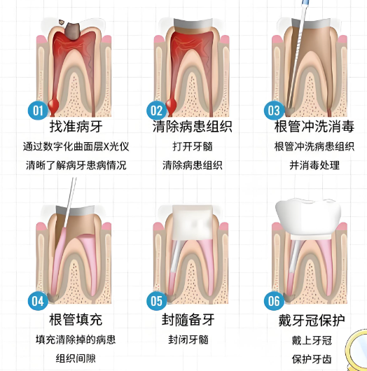 根管治疗三次哪次最贵?分别