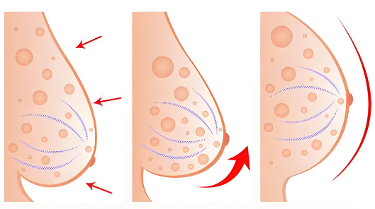 做乳房悬吊术使用的什么设备?