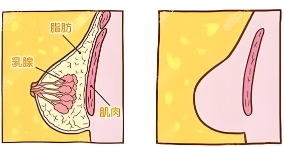 女性胸太大可不能随意做乳房缩小术? 