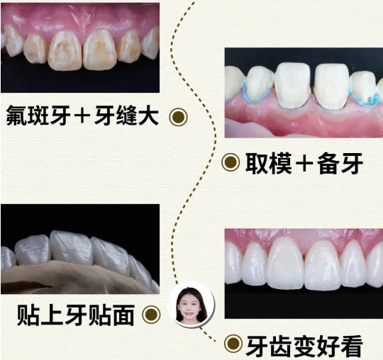 全口氟保护漆的价格是多少