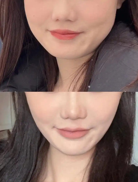瘦脸手术后脸部变化影响