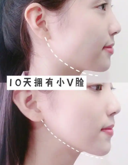  保&妥适瘦脸项目价格