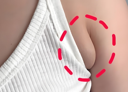 副乳yiding要手术切除吗