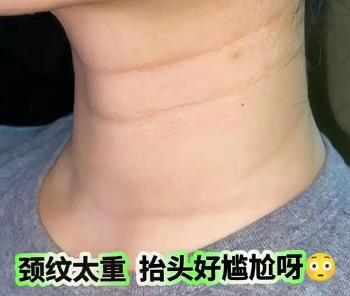去除颈纹采用什么设备
