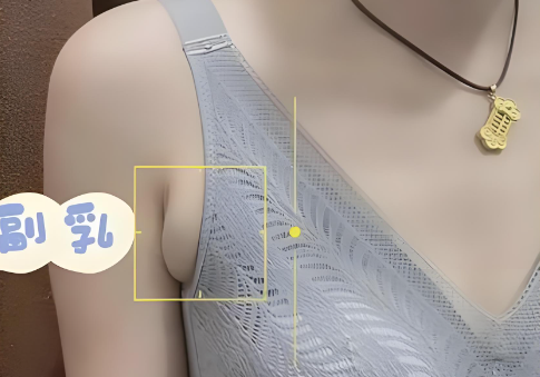 什么样的副乳需要切除