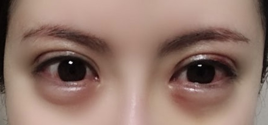 如何去除眼部鱼尾纹