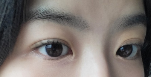 自体脂肪填充卧蚕有风险吗？