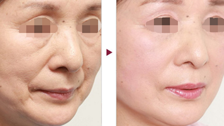 Radiofrequency skin tightening