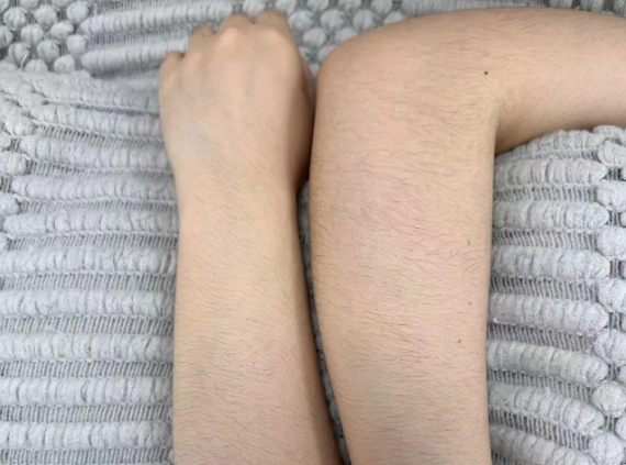 Limb hair removal