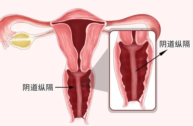 Vaginal reconstruction