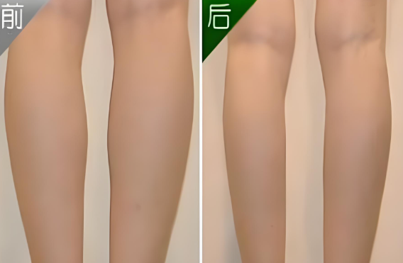 Calf liposuction