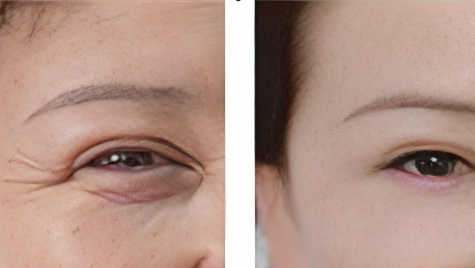 IPL wrinkle removal