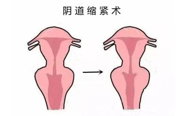 Vaginal tightening