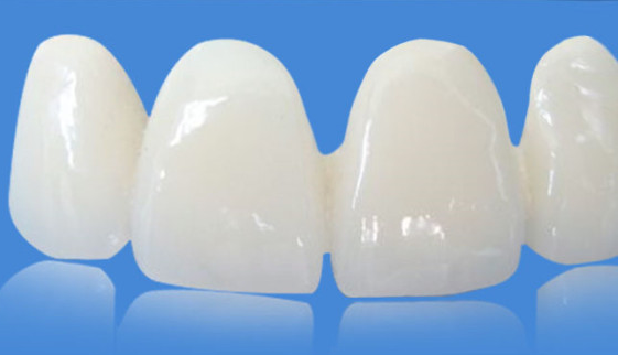 Cosmetic all-ceramic crown