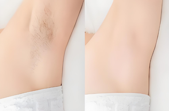 Freezing point hair removal