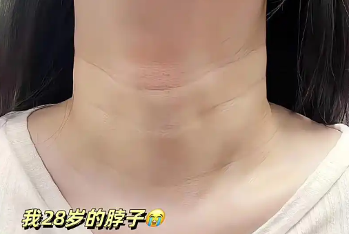 Neck wrinkles