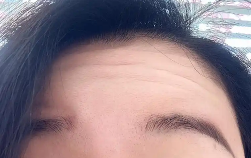 Forehead wrinkles