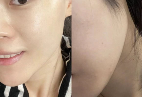 Facial Hair Removal