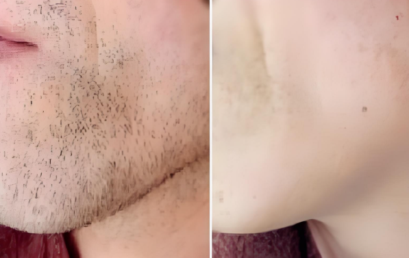 Beard Hair Removal