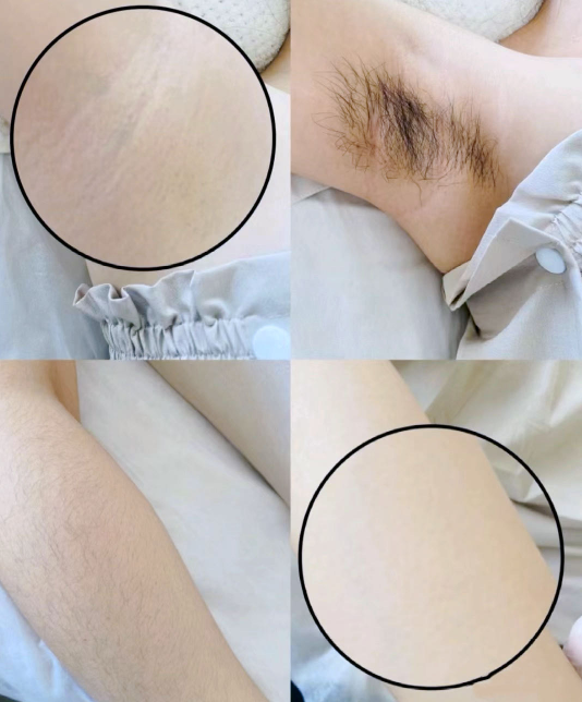 腋下脱毛后可以涂抹香水吗？  
