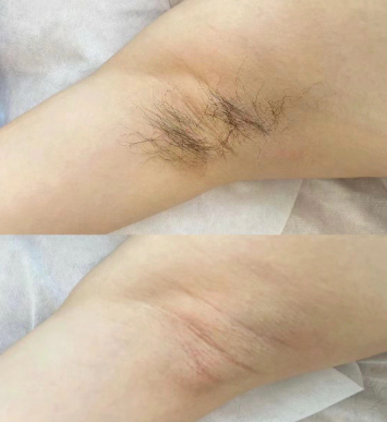 腋下脱毛后能做按摩吗？