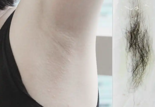 腋下脱毛的效果与毛发颜色有关吗？