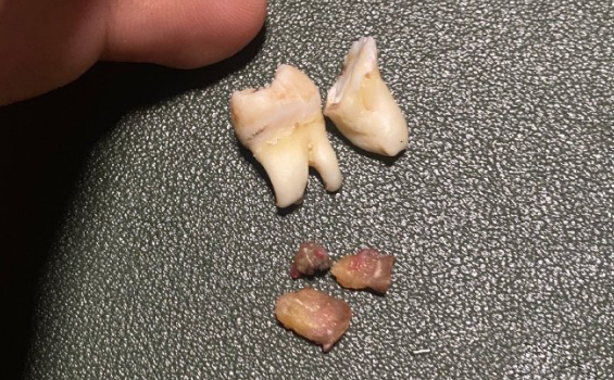 残根拔除后什么时候可以吃东西？