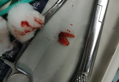 残根拔除术后如何护理？