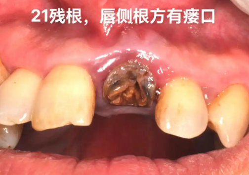 残根拔除能否避免牙齿感染？