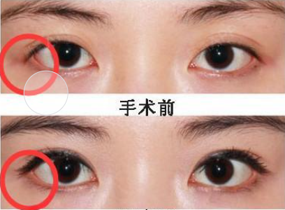 开外眦手术前是否需要进行皮肤测试？ 