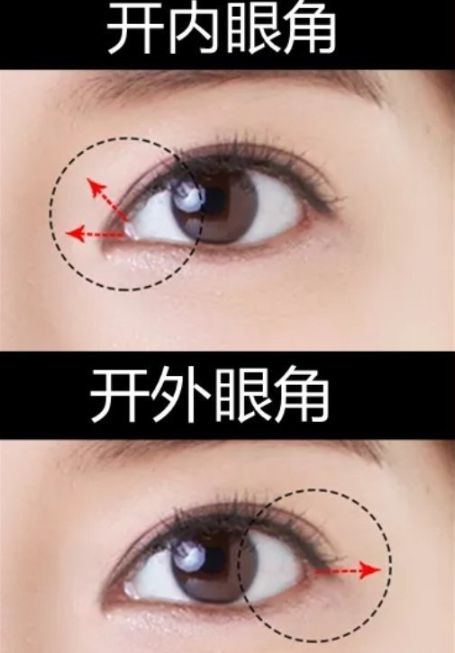 开外眦手术后多久可以恢复日常活动？