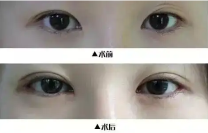 开外眦手术前应该避免哪些行为？