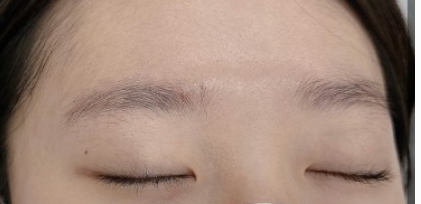 提眉手术前应该避免哪些行为？