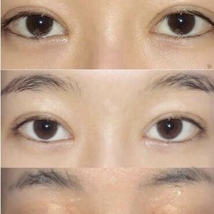 重睑手术有哪些常见方法？