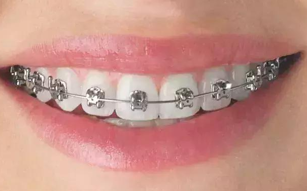 牙齿自锁托槽矫正是否比传统矫正快？