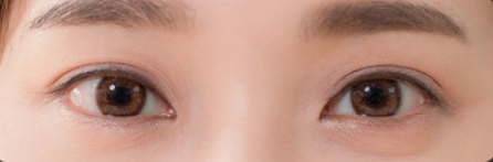 双眼皮术后如何护理？