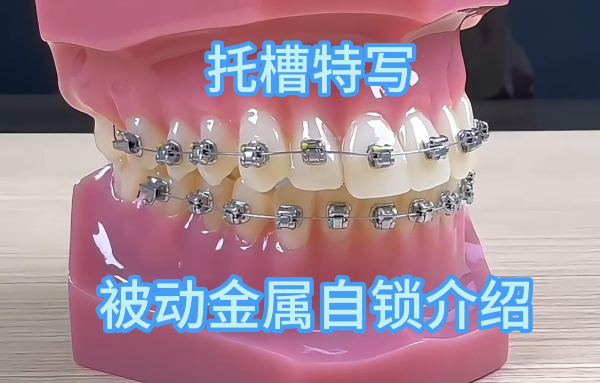 牙齿自锁托槽矫正需要多长时间？