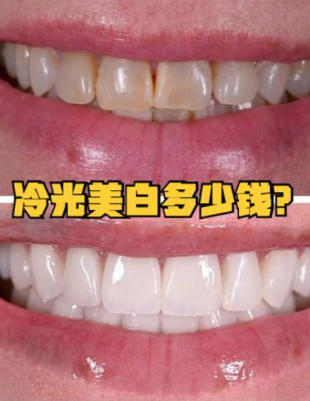 冷光美白牙齿疼吗