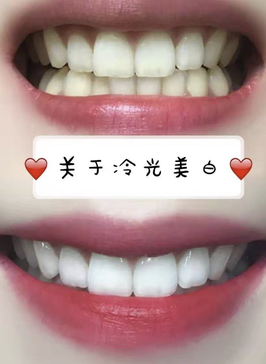 冷光美白牙齿多久做一次