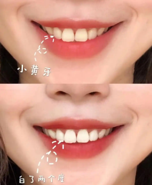 冷光美白牙齿后注意事项