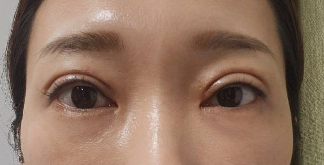 如何选择合适的双眼皮医生？