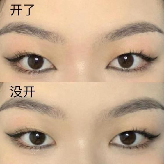 开眼角的手术费用是多少？