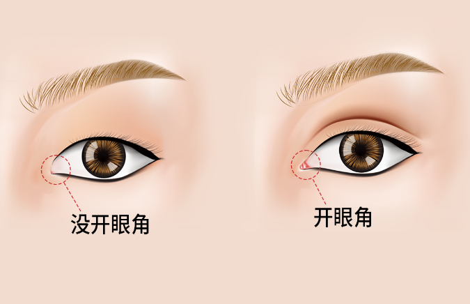 开眼角会有疤痕吗？